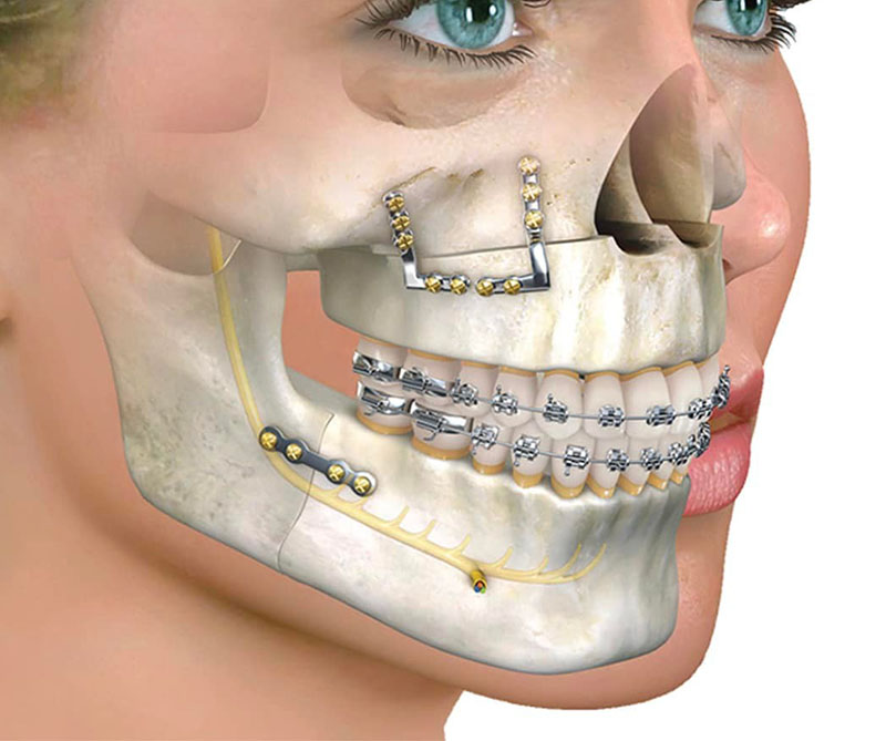 pinnacle-oral-surgery-rockwall-texas-orthognathic-surgery-v2